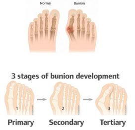 BORT Valco® Hallux Valgus Splint, Bunion Regulator -752