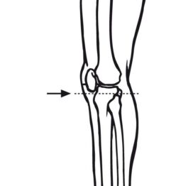 Patella Measurement